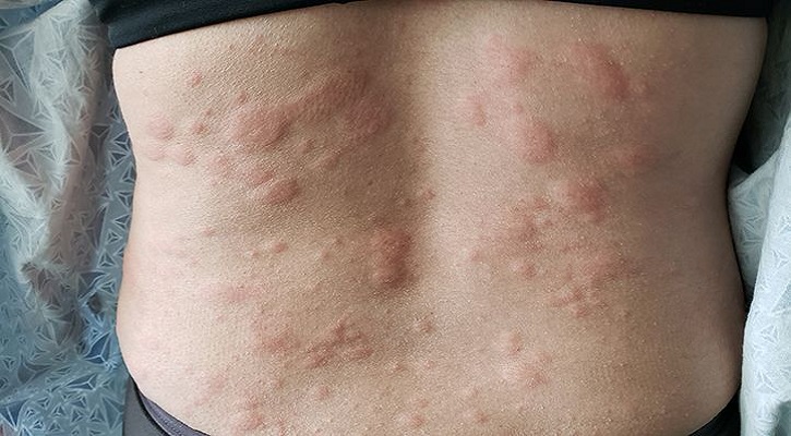 Hives Urticaria